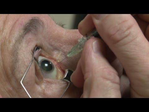 Intravitreal Injections