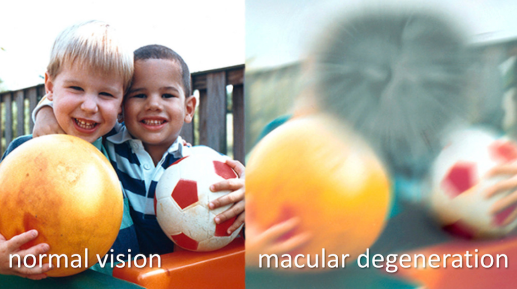 Before and after macular degeneration