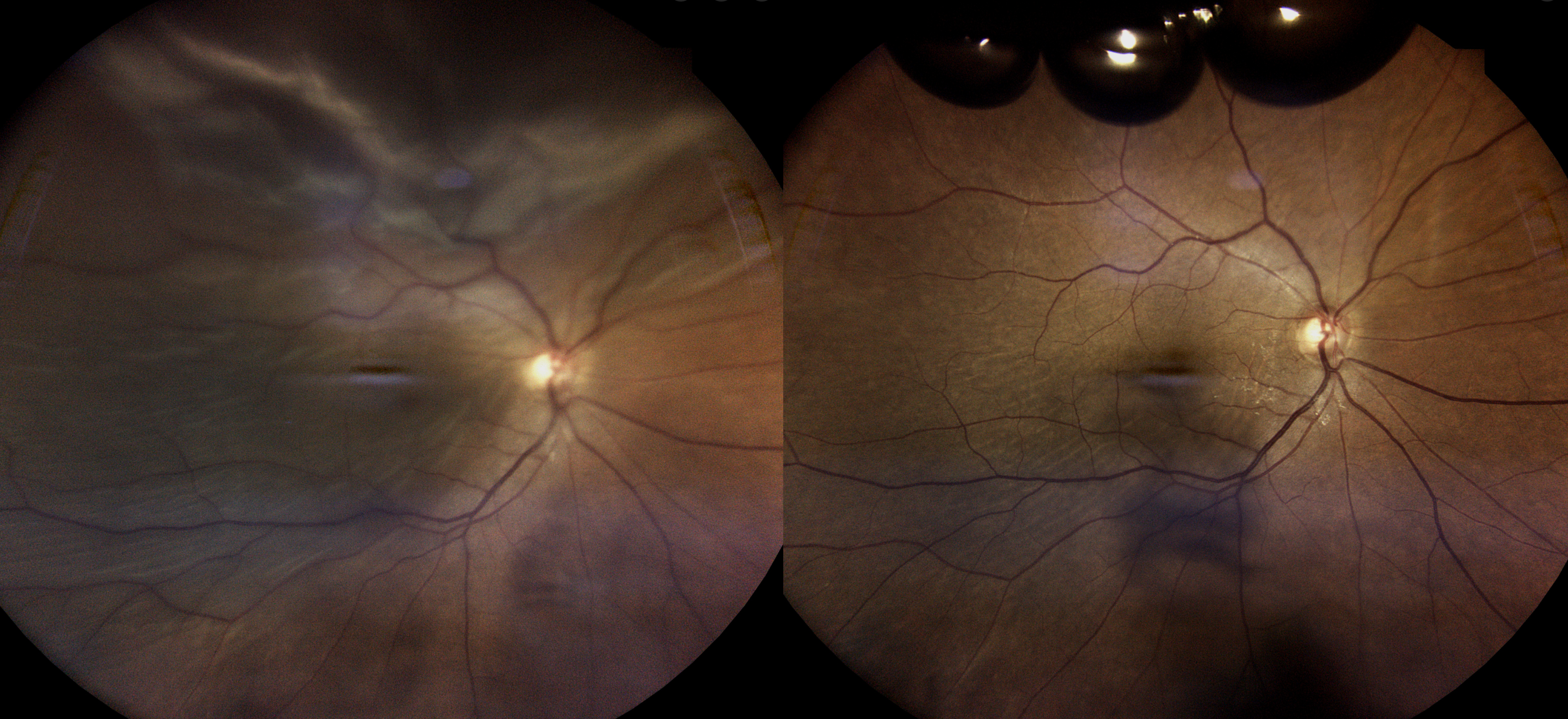 Pneumatic Retinopexy