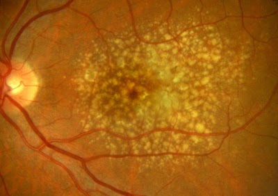 Dry macular degeneration