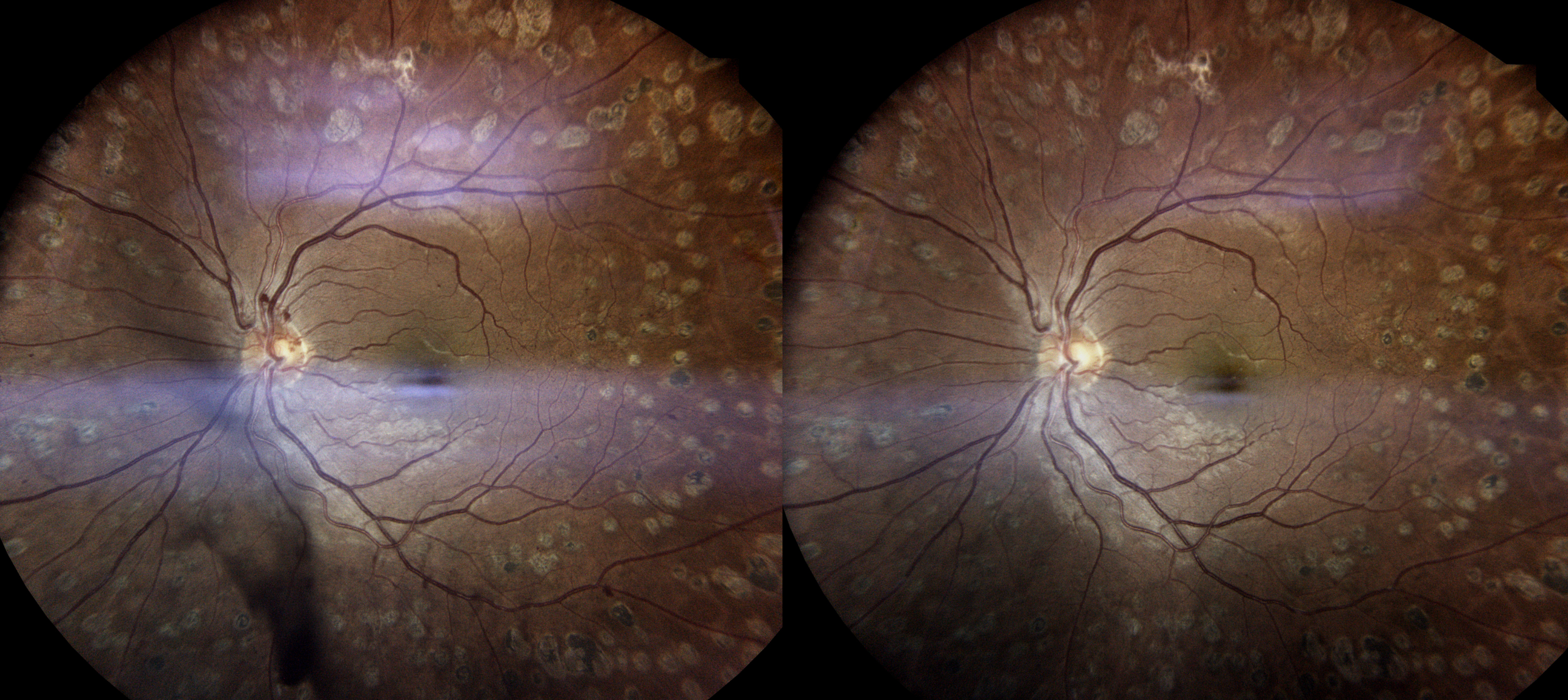 Vitreous Hemorrhage