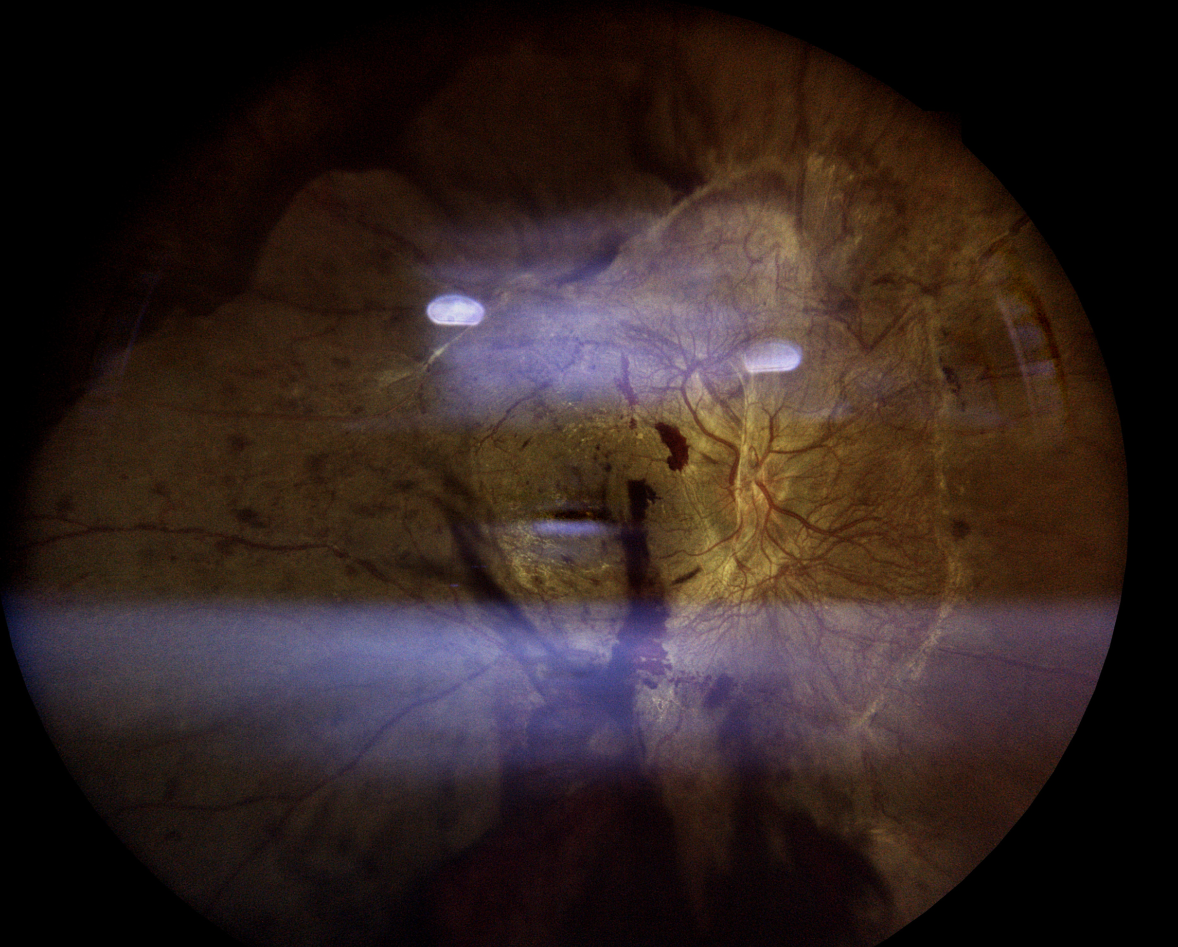 Diabetic Retinopathy