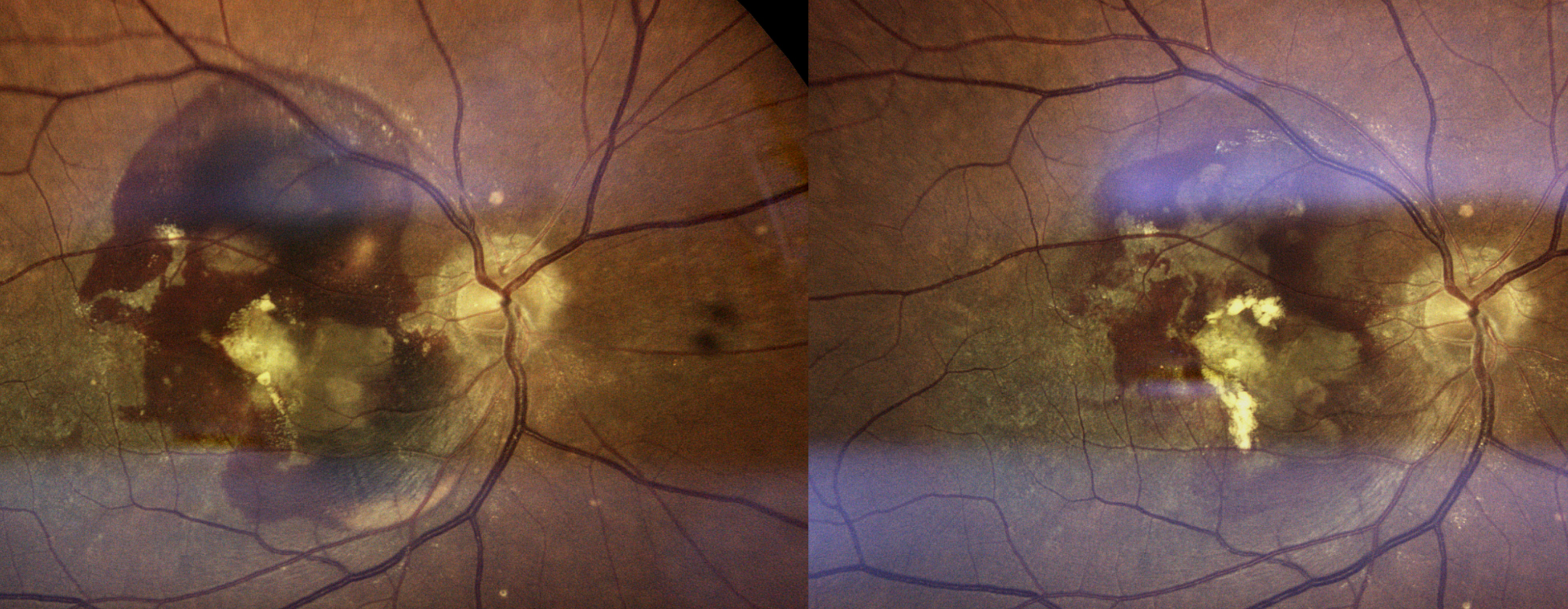 Wet Macular Degeneration