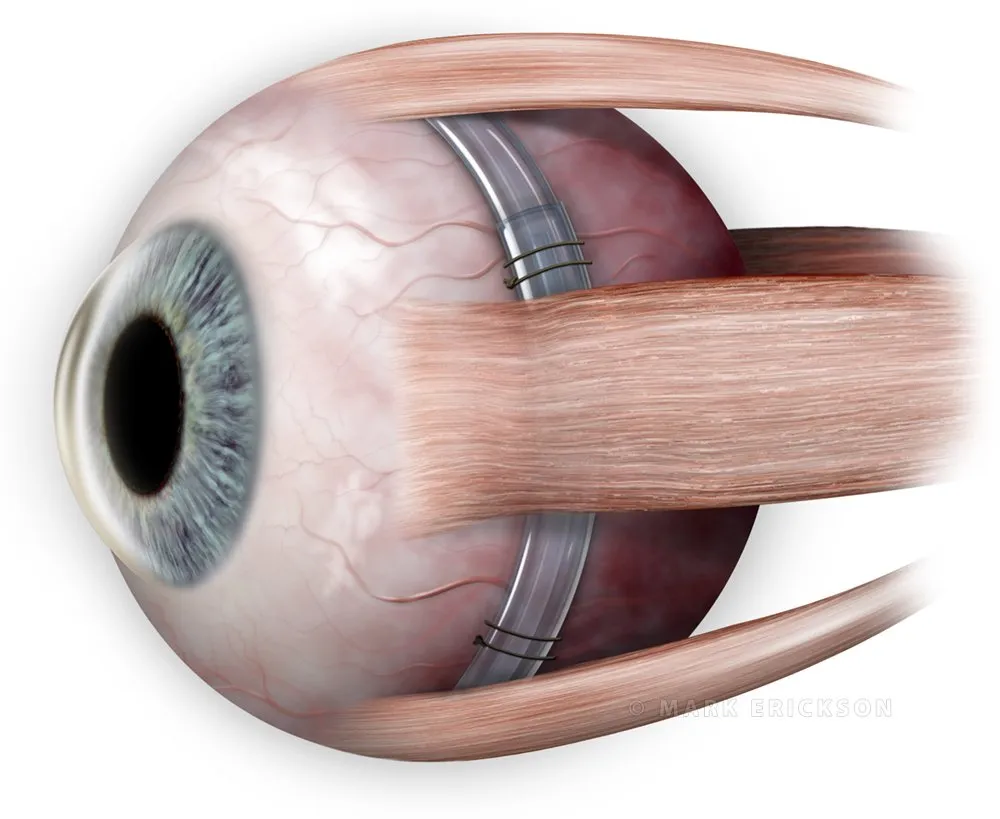 Scleral Buckle Surgery