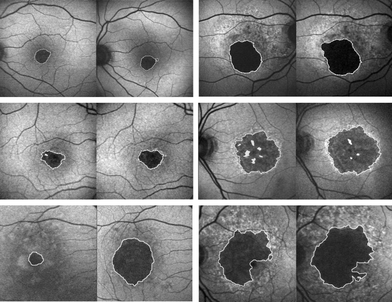 Fundus Autofluorescence