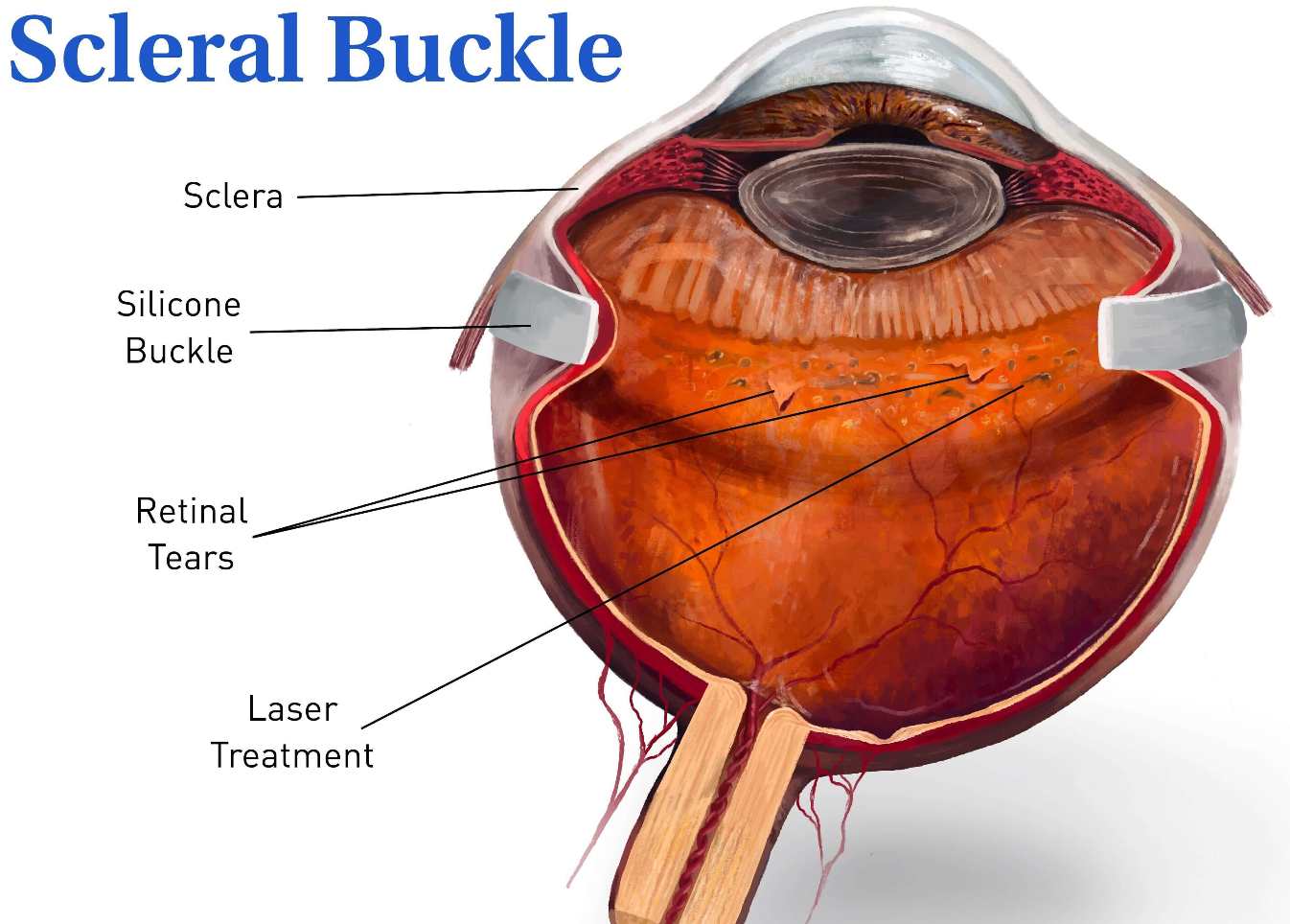 Scleral Buckle Surgery