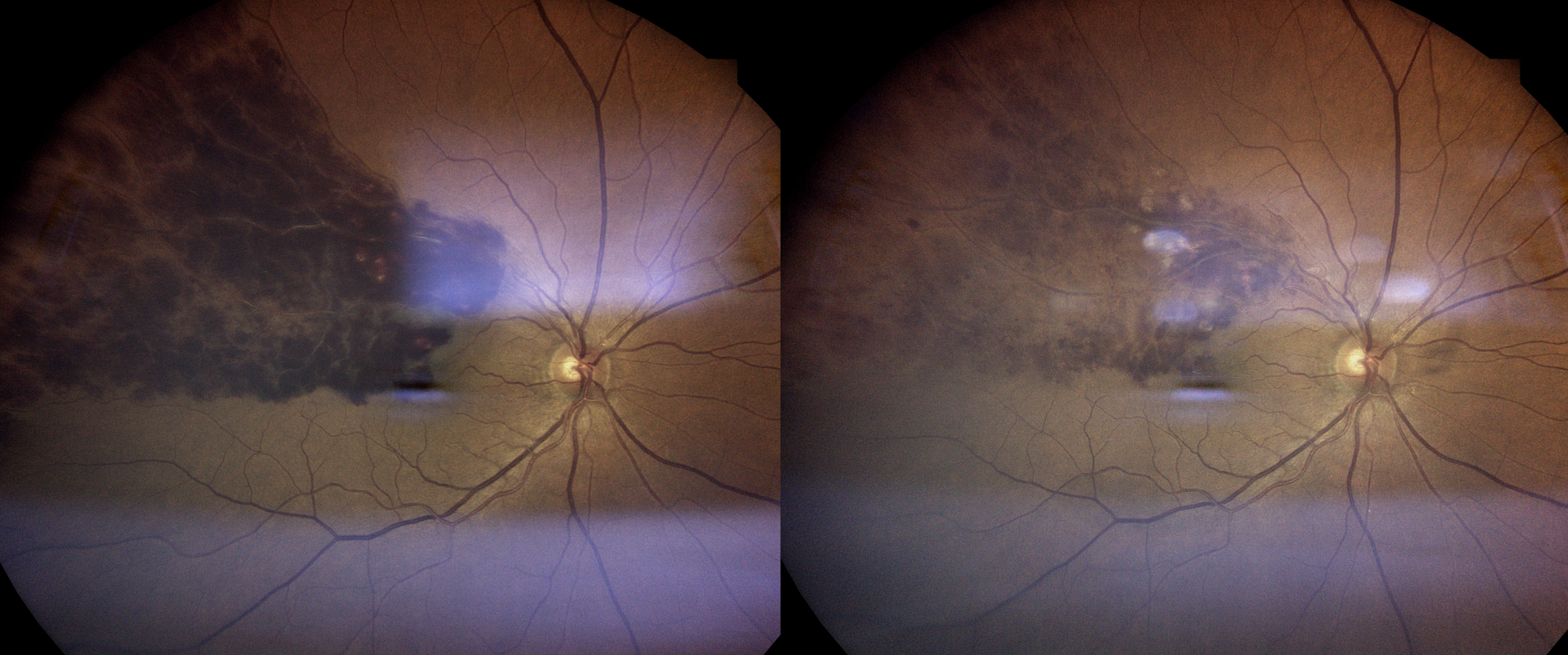 Retinal Vein Occlusion