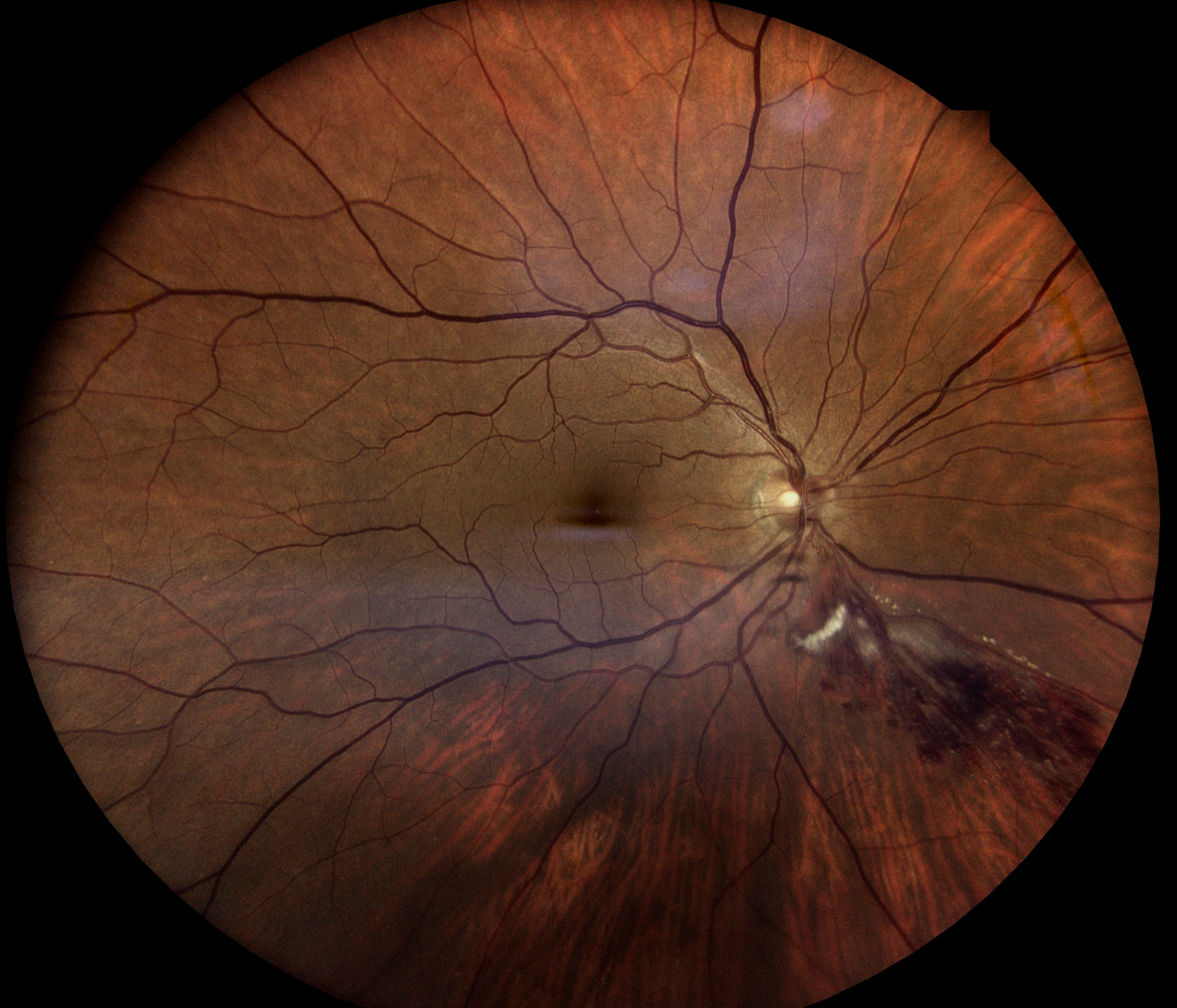 Retinal Vein Occlusion