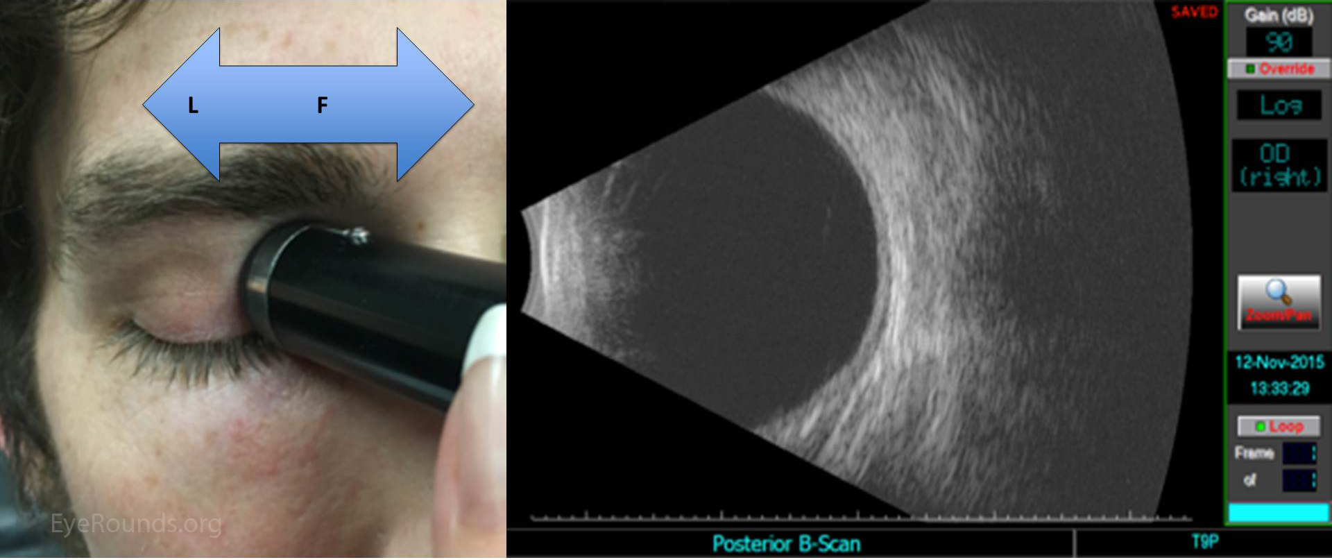 Ophthalmic Ultrasonography (B-Scan)