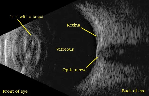 Ophthalmic Ultrasonography (B-Scan)