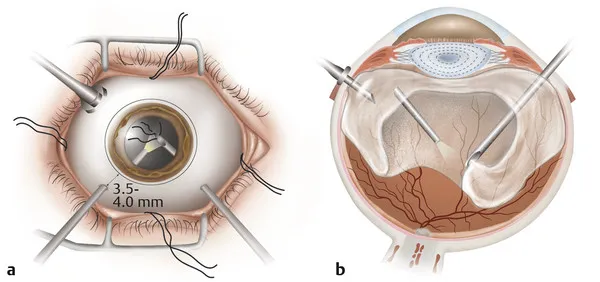 Vitrectomy Surgery