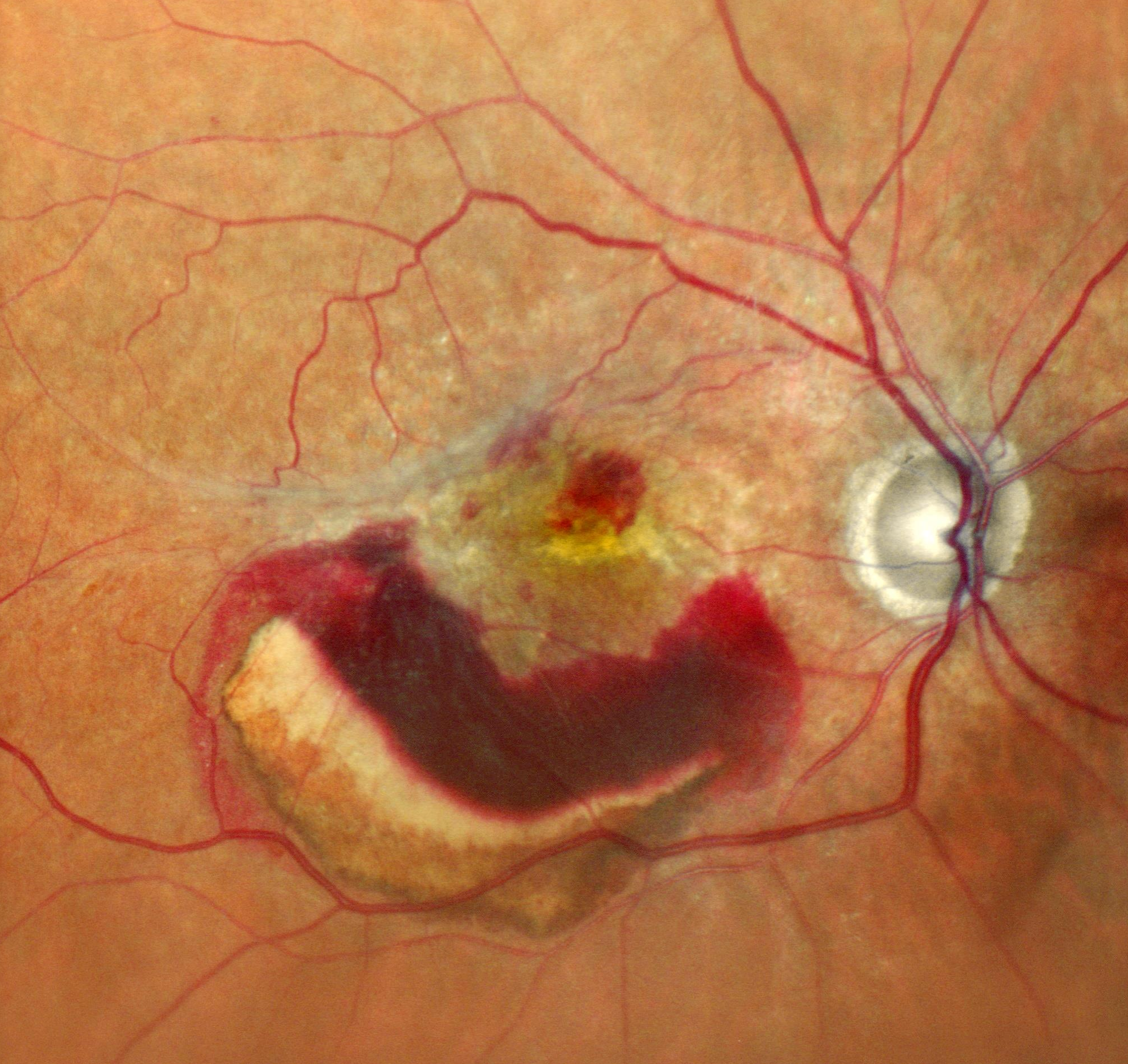 Wet Macular Degeneration