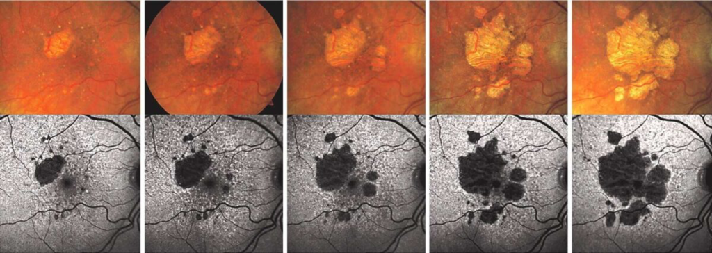 Macular degeneration