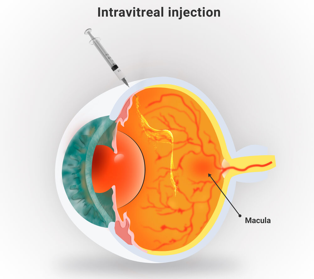 Intravitreal Injections