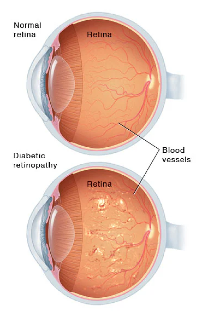 Diabetic retinopathy