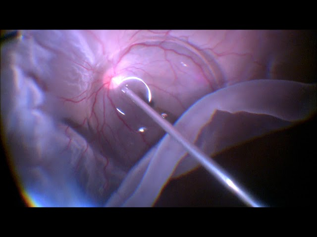 Vitrectomy Surgery