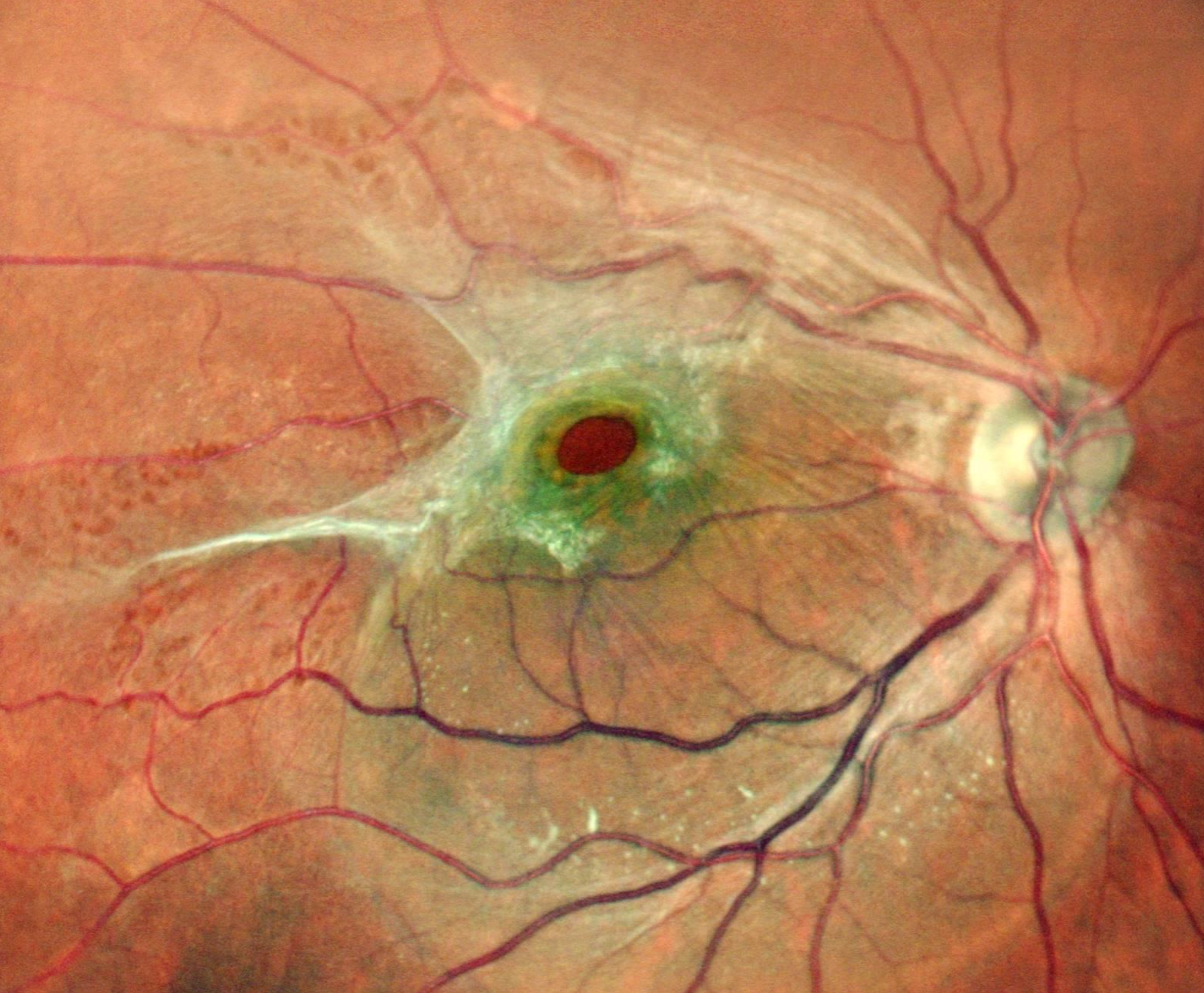 Macular Hole