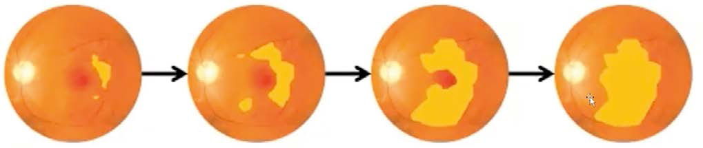 Macular degeneration