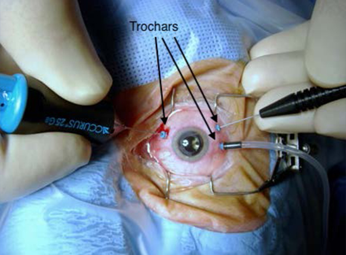 Vitrectomy Surgery