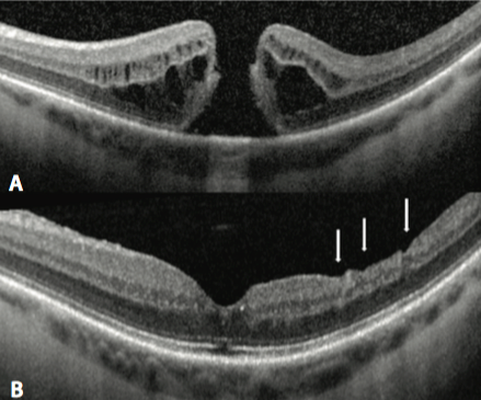 Macular Hole