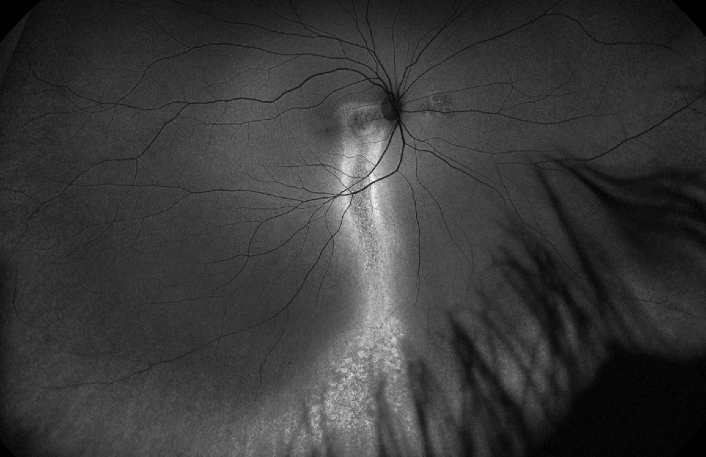 Central Serous Retinopathy