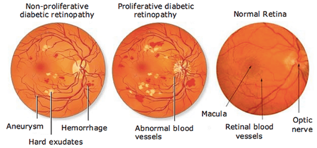 Diabetic Retinopethy