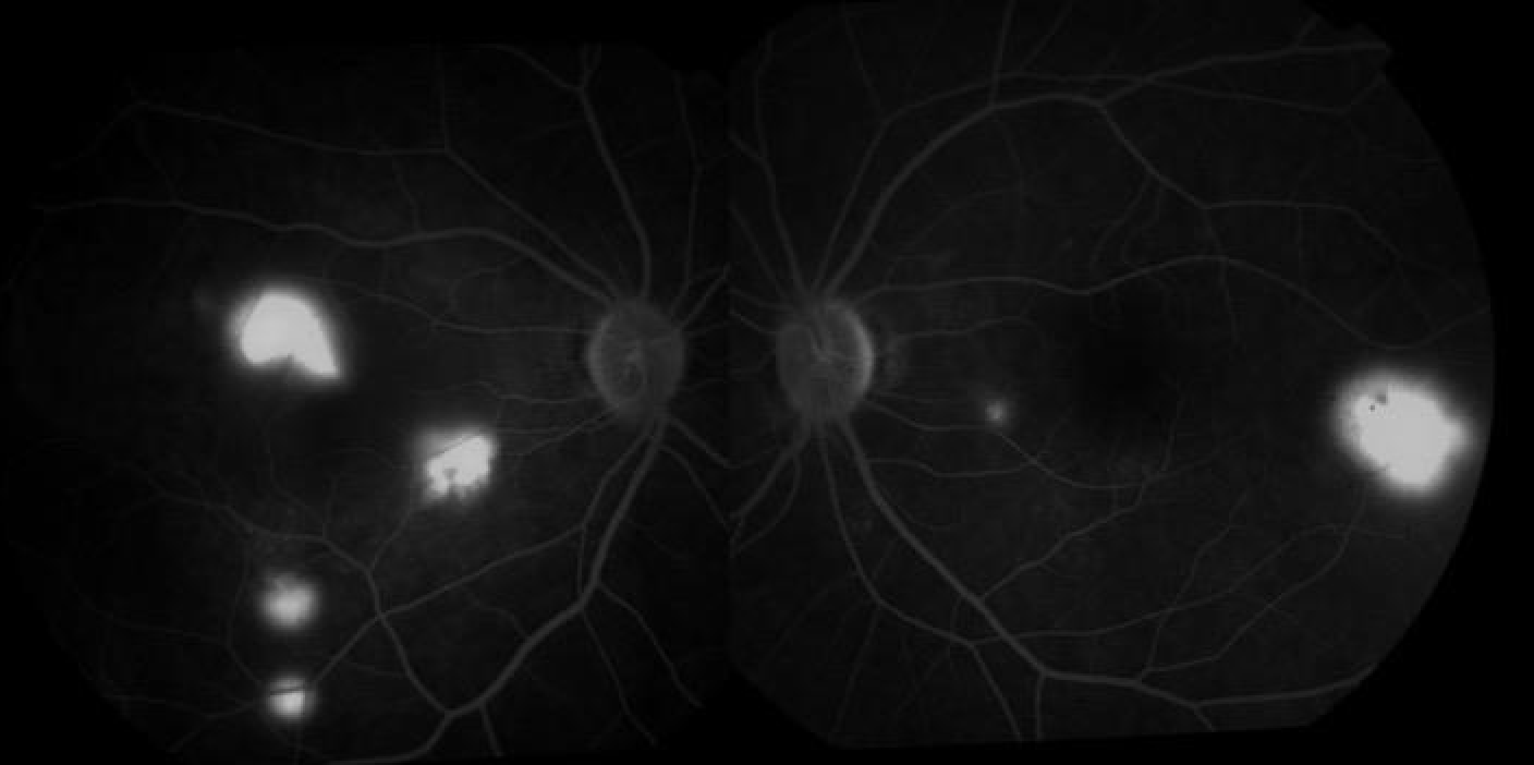 Central Serous Retinopathy