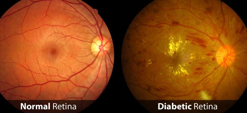 Diabetic retina