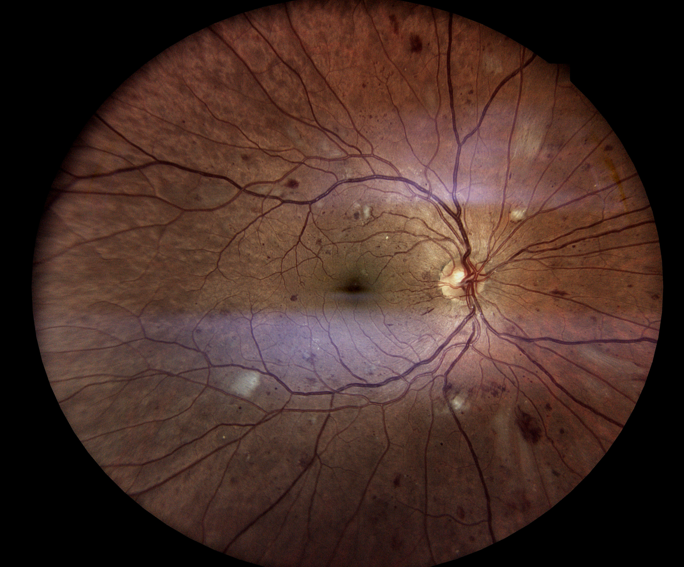 Diabetic Retinopathy