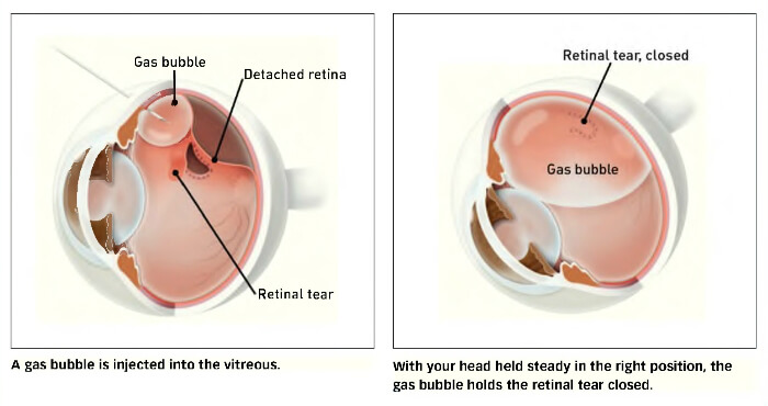 Pneumatic Retinopexy