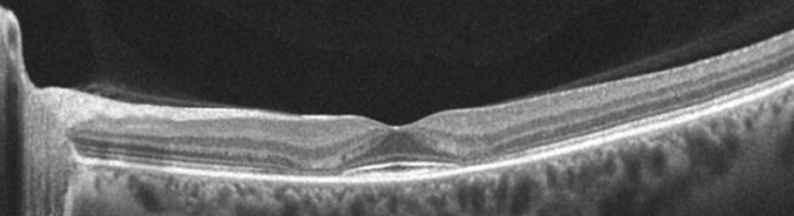 Plaquenil (Hydroxychloroquine) Screening