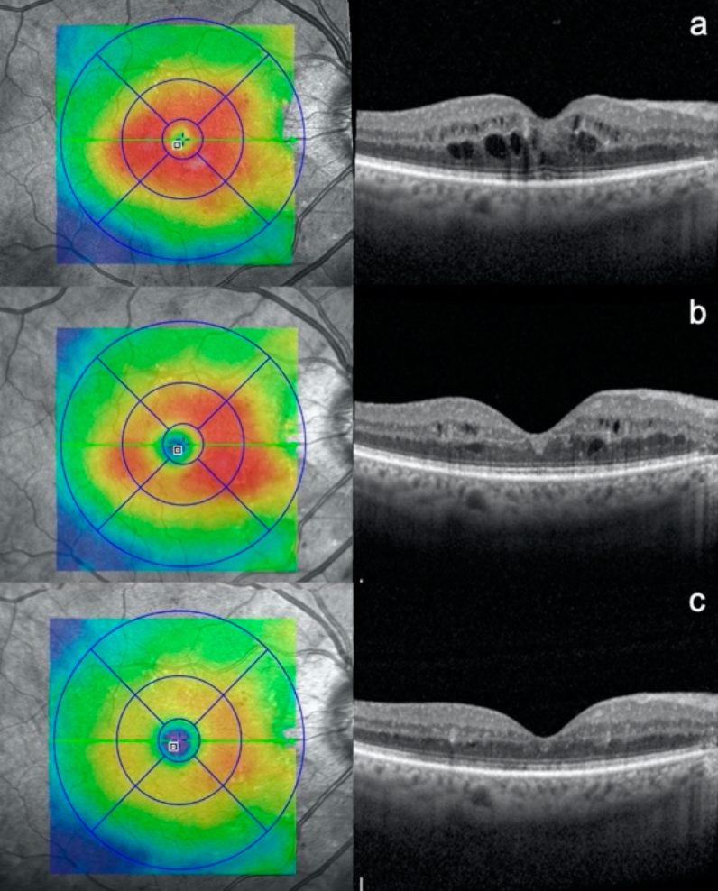 Diabetic macular edema scan