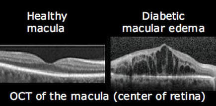 Dabetic macular edema