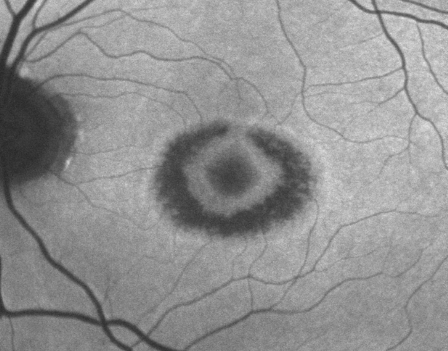 Plaquenil (Hydroxychloroquine) Screening