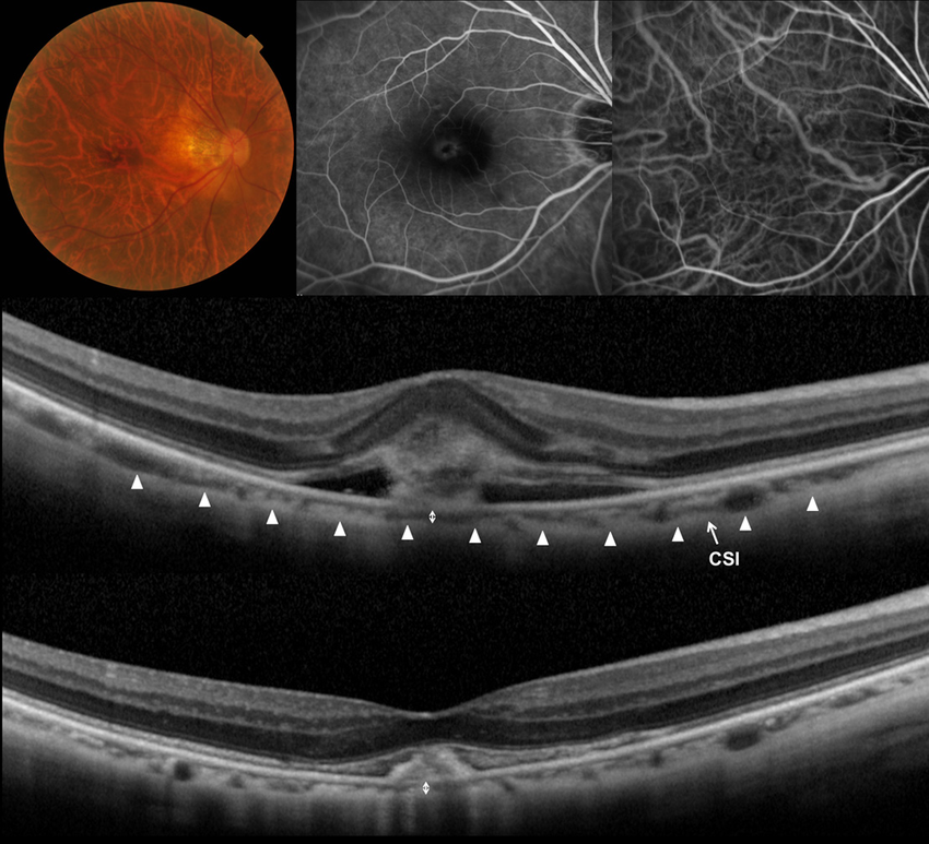 Myopic Degeneration