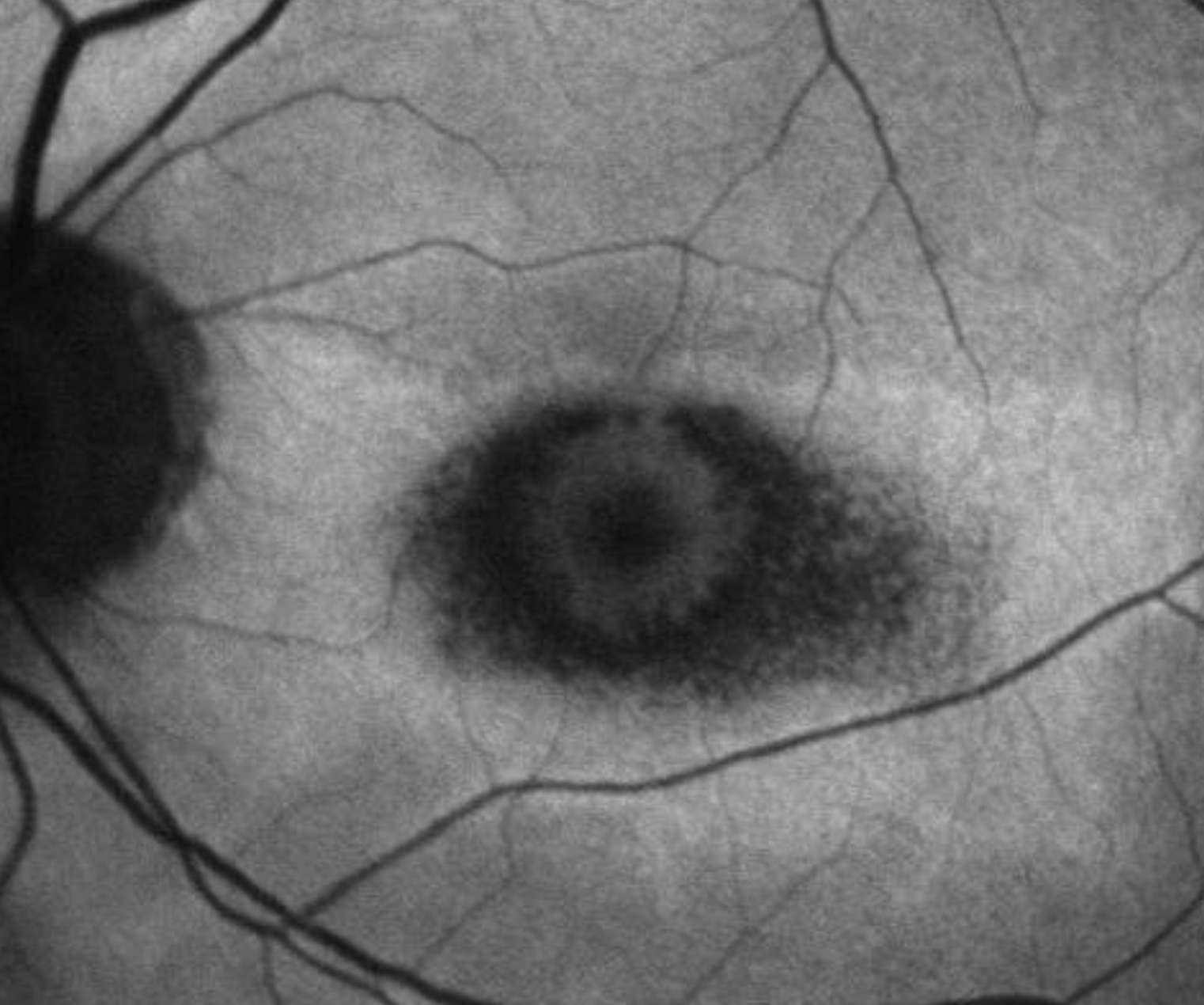 Plaquenil (Hydroxychloroquine) Screening