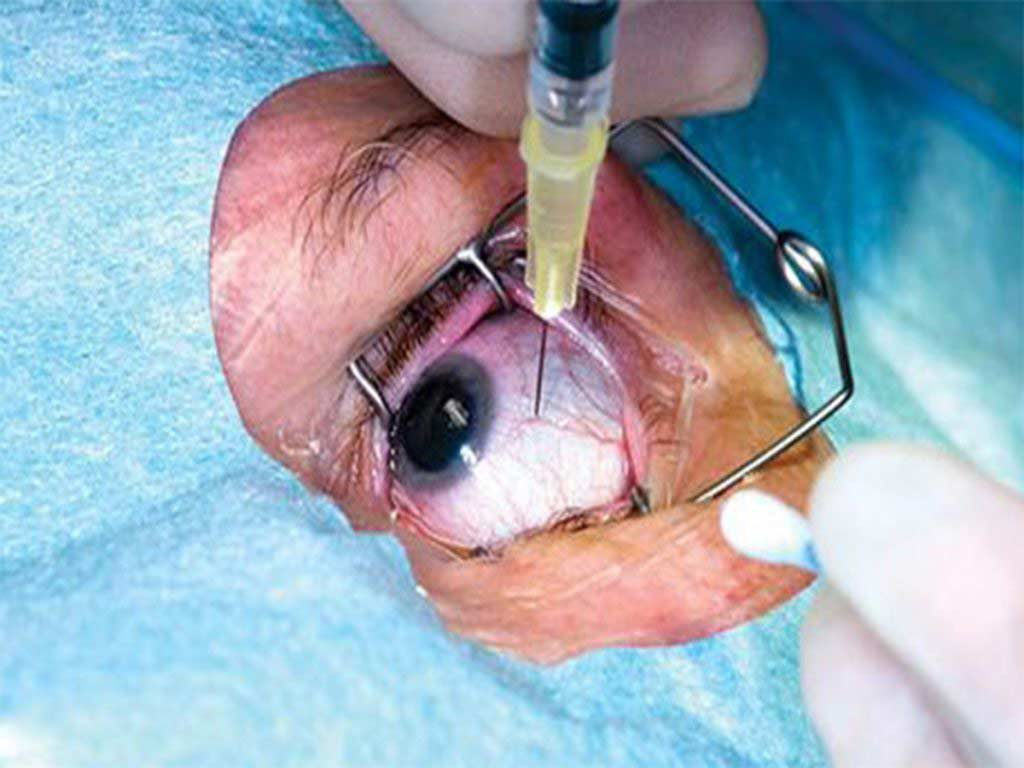 Intravitreal Injections