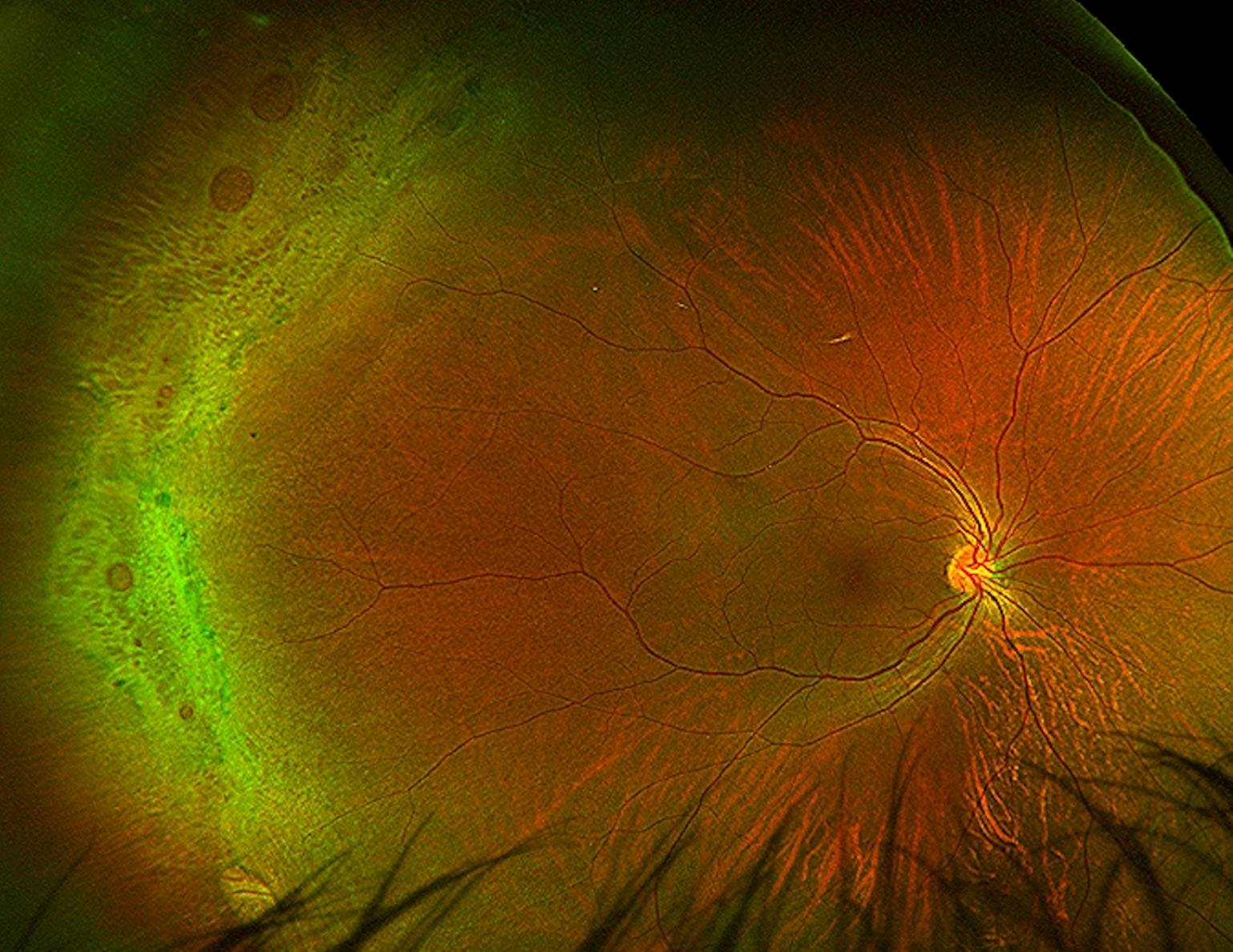 Retinal Holes