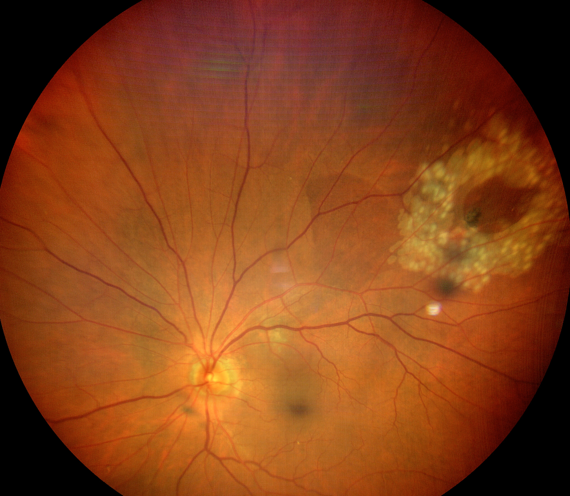 Retinal Holes