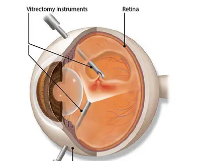 Vitrectomy Surgery