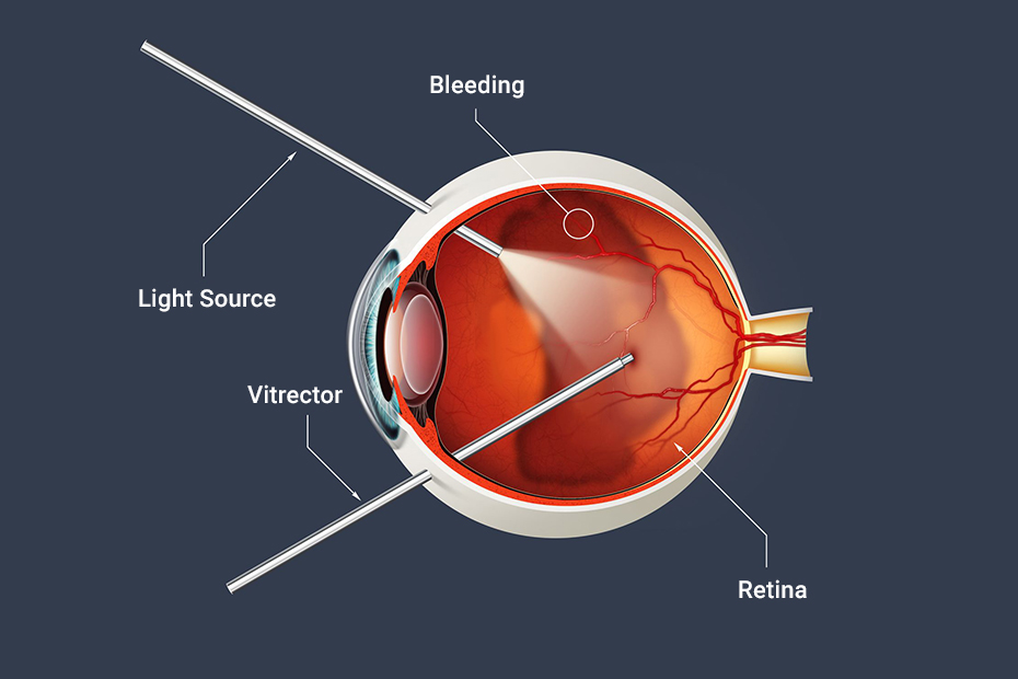 Vitrectomy Surgery