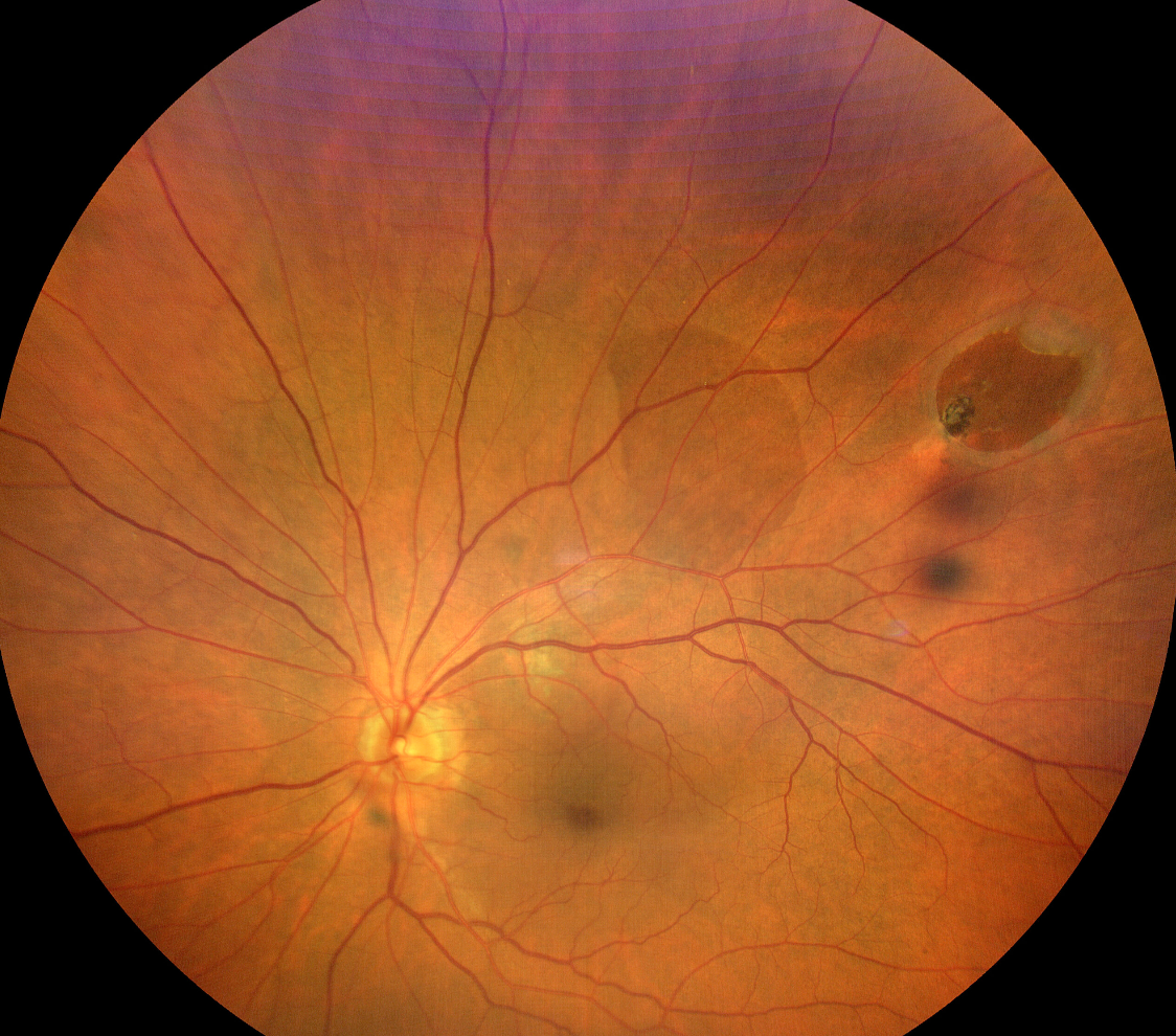 Retinal holes