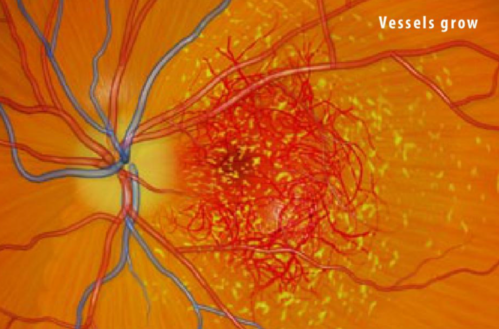 Macular degeneration vessels growing