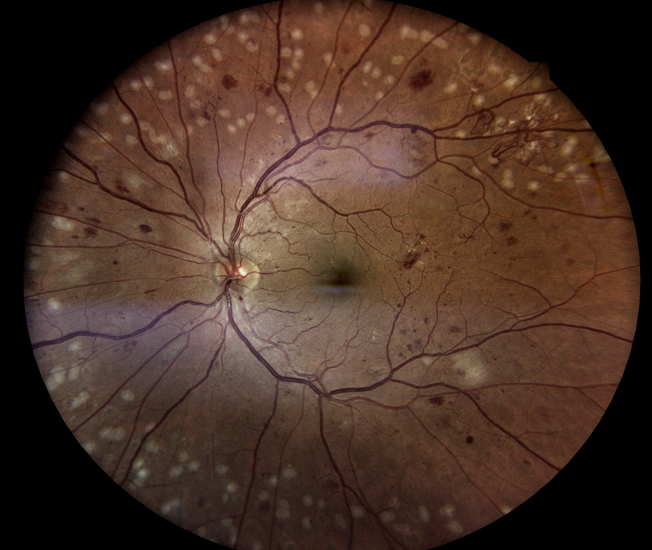 Diabetic Retinopathy