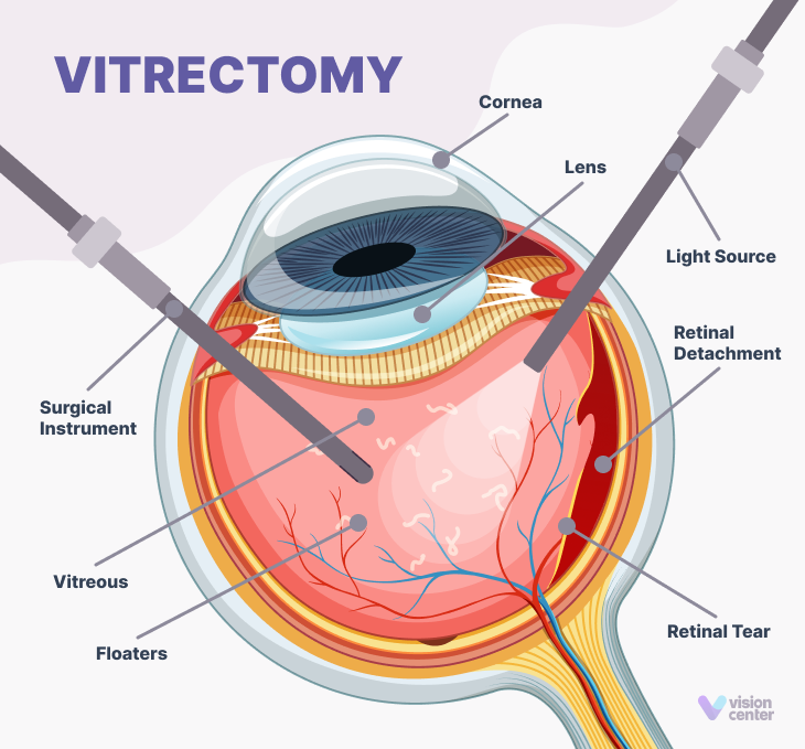 Vitrectomy Surgery