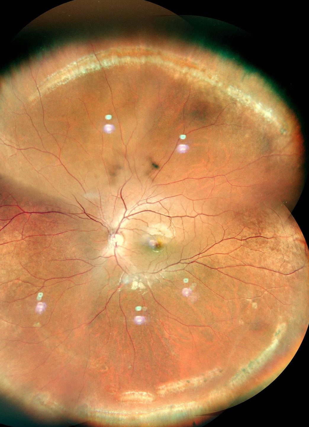 Lattice Degeneration of the Retina