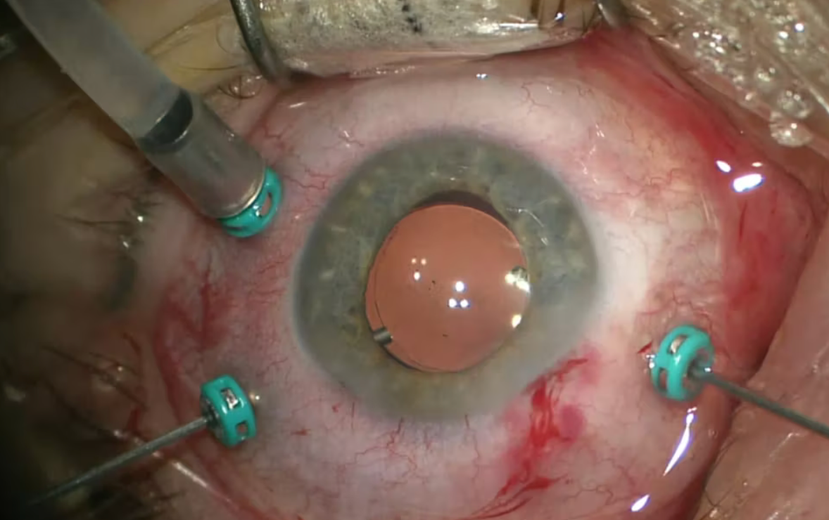 Vitrectomy Surgery