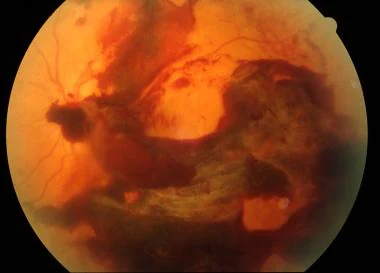 Vitreous Hemorrhage