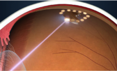 Retinal Laser Therapy