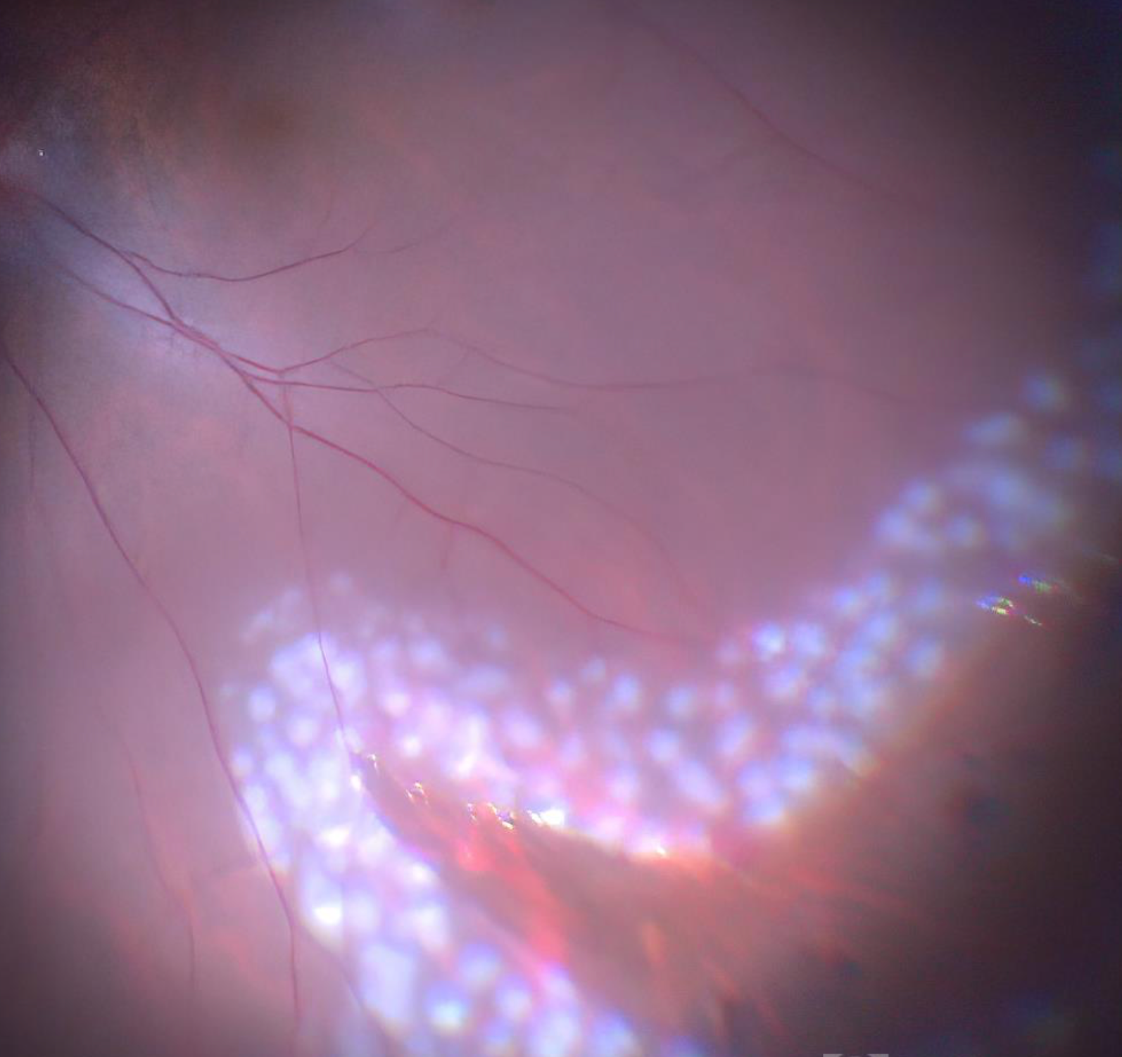 Retinal Laser Therapy